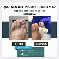 Heloma infiltrado antes y después
