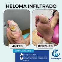 Granuloma antes y después